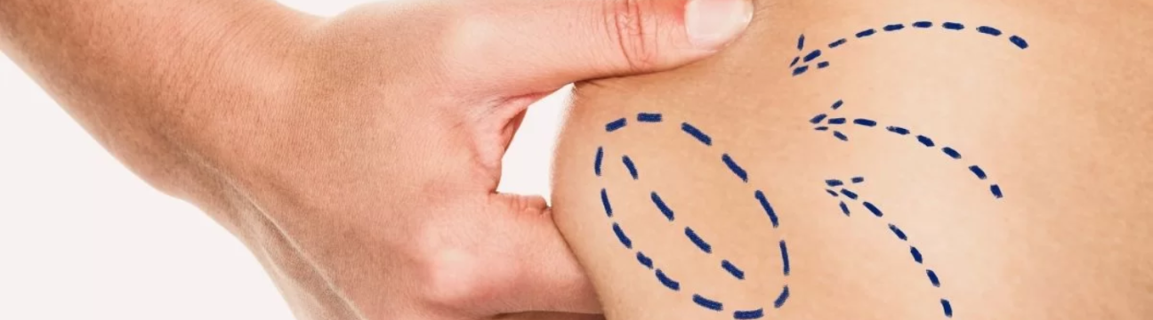 Liposuction Surgery