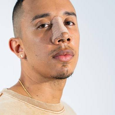 Rhinoplasty  In Riyadh